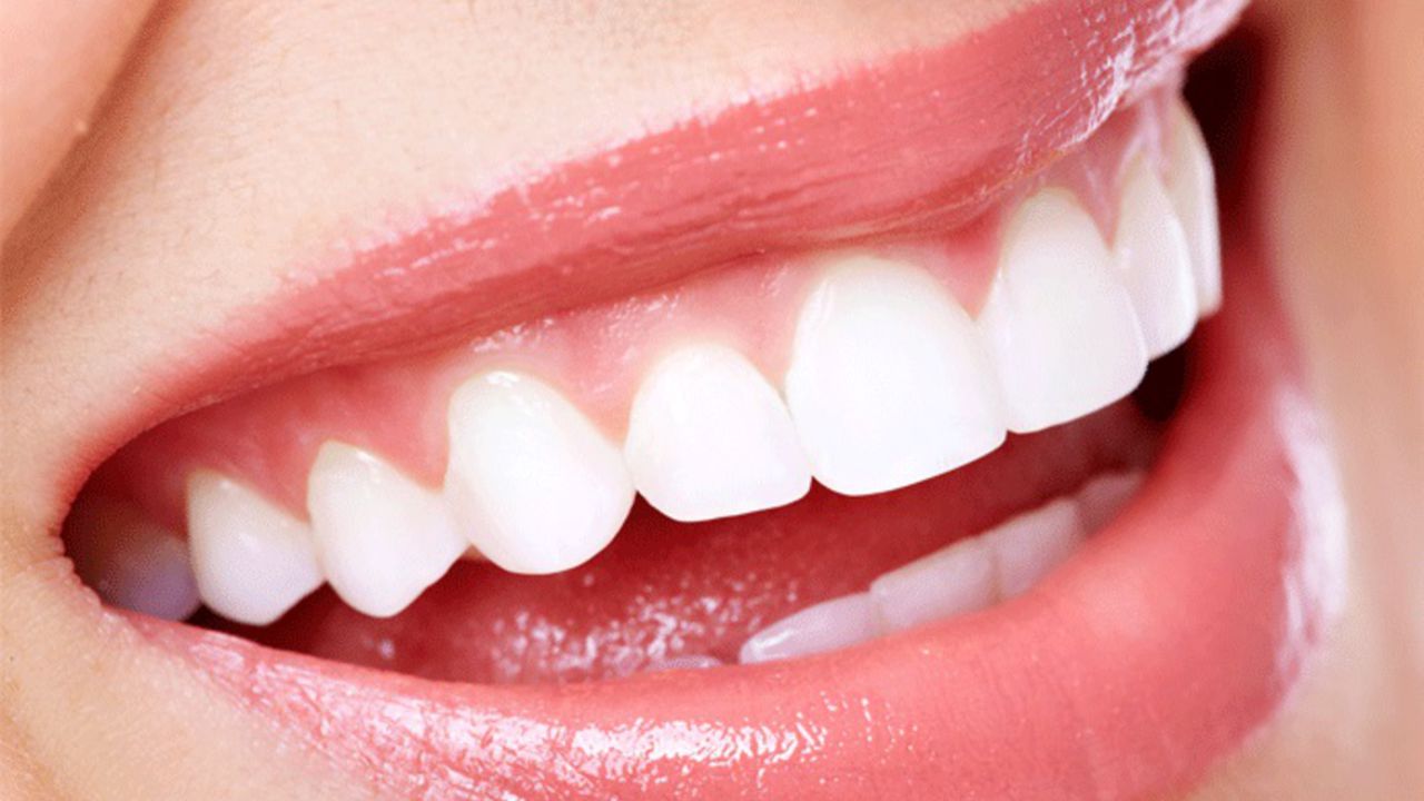 implant_dentaire_beau_sourire