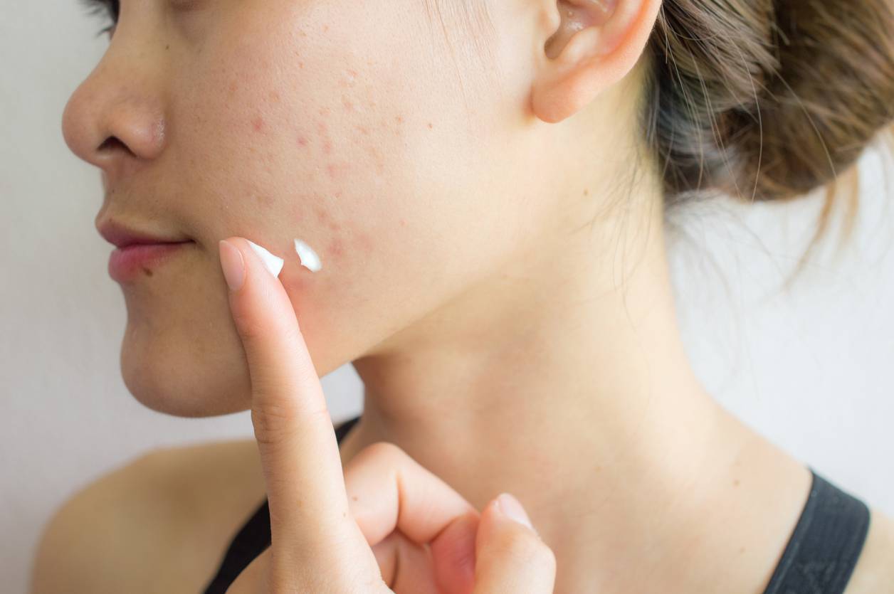 se débarrasser de l'acné , ado comment éliminer acné ; crème contre acné